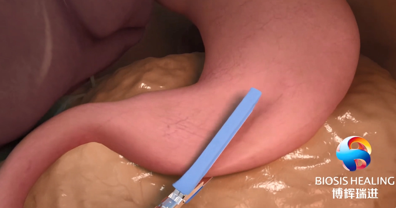 Penguatan garis staples (SLR) untuk mengurangi kebocoran