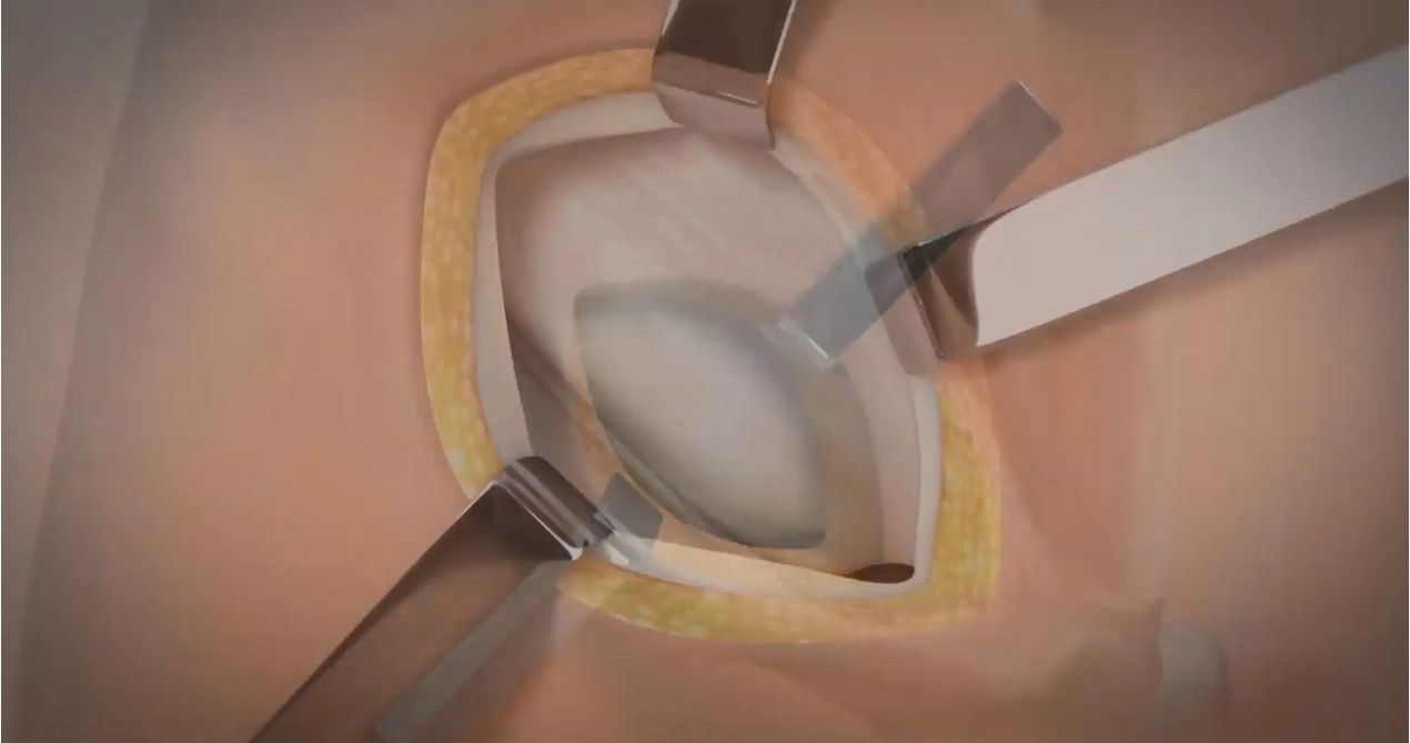 Perbaikan Hernia Lichtenstein dengan jaring yang dapat diserap SIS