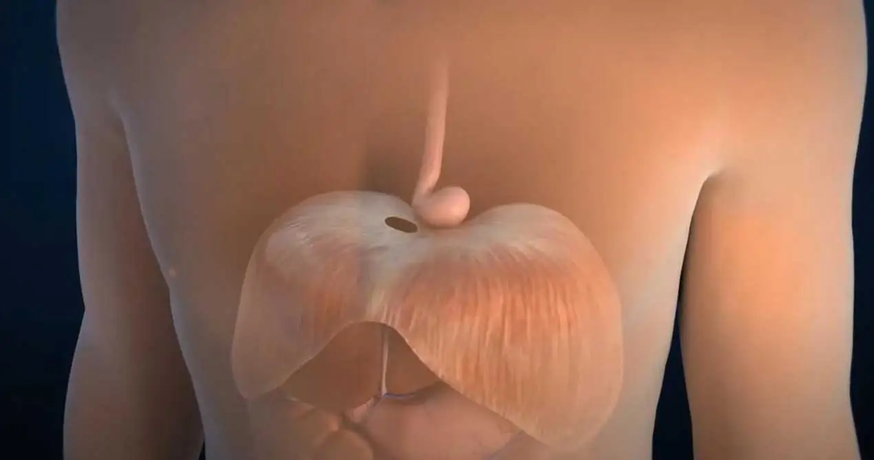 Sophageal Hiatus Hernia perbaikan dengan SIS Biological Meshes