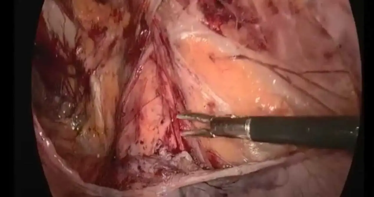 SIS Biological Mesh 13x15cm TAPP operasi untuk perbaikan Hernia