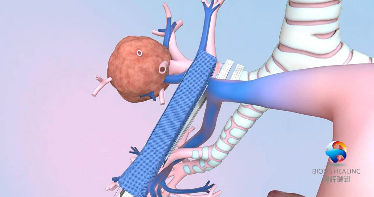 Penguatan garis staples untuk lobecy