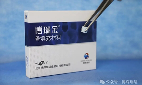 Produk bahan Graft tulang vidaris resmi memperoleh sertifikasi, dan keluarga oral penyembuhan Biosis menyambut lainnya